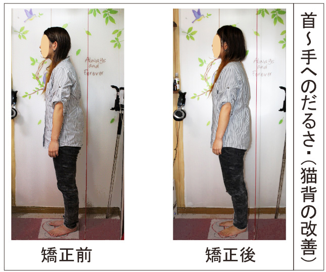 猫背施術